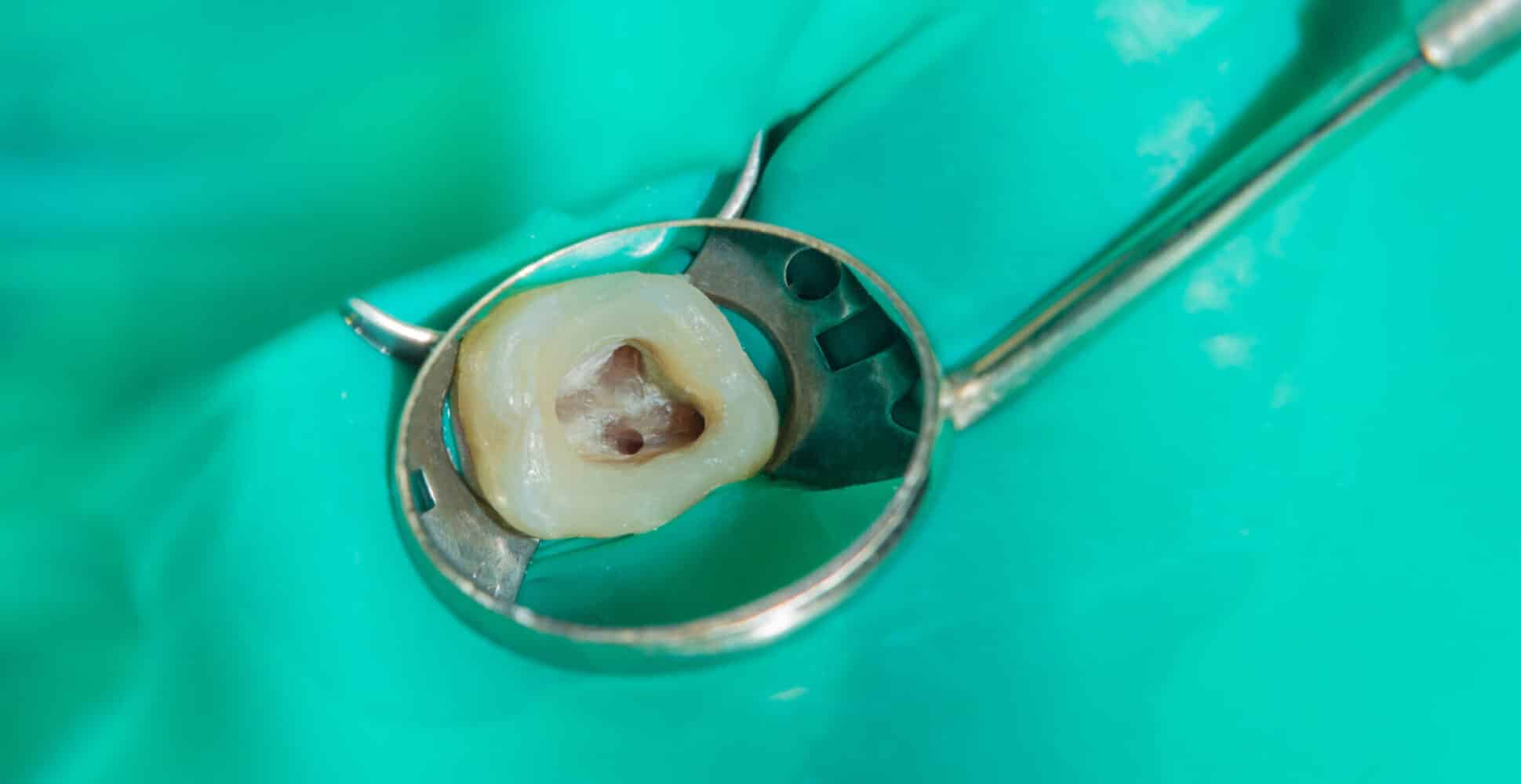 endodontic treatment of teeth close-up.